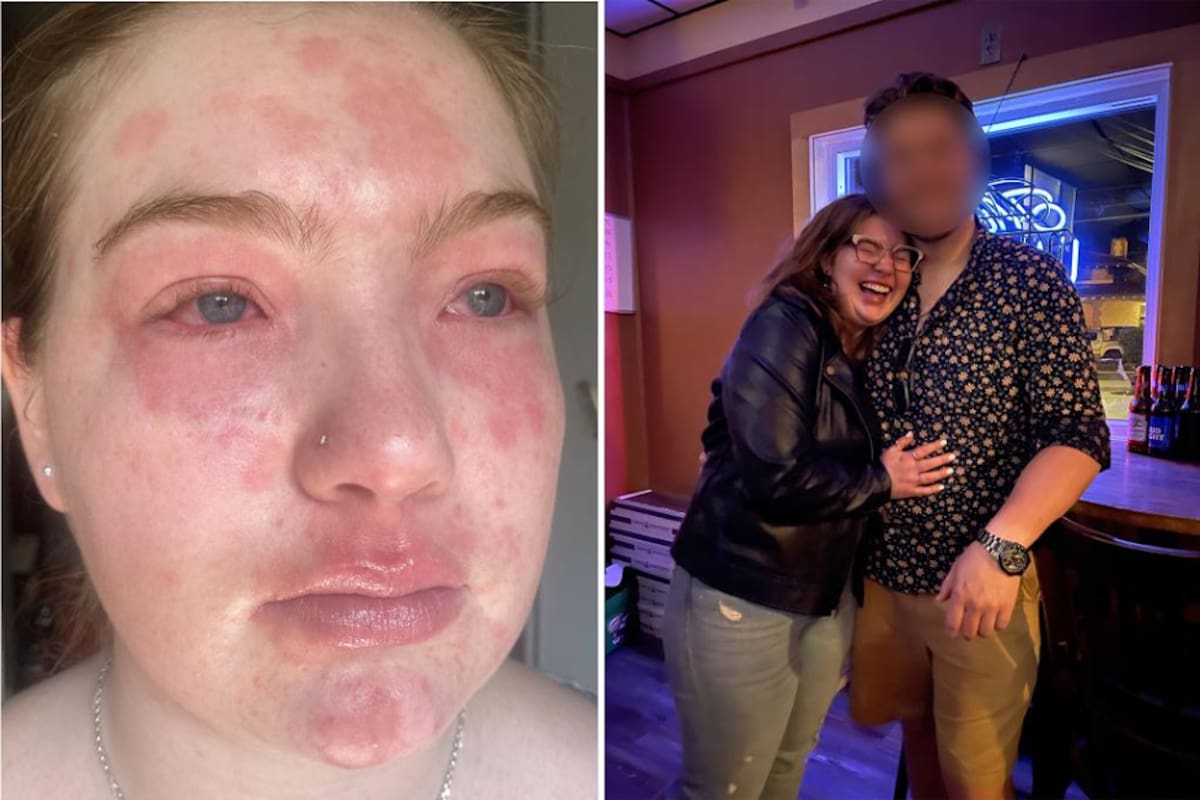 VIRAL: Joven asegura ser alergica a su propio novio